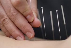 acupuncture-1-300x201
